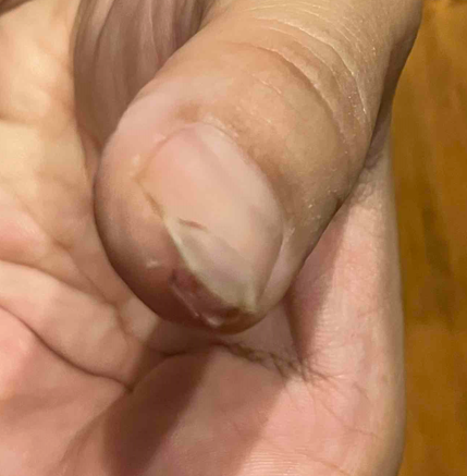 指を切った写真